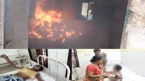 tikamgarh, Two children scorched , during treatment