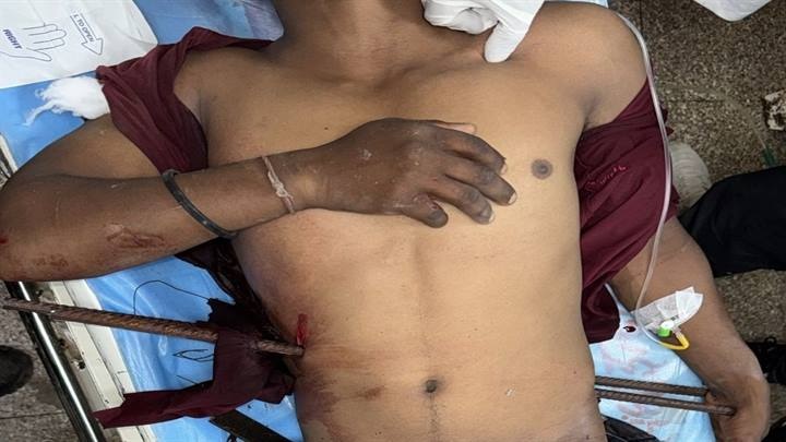 indore, Complex surgery,  remove iron rods  